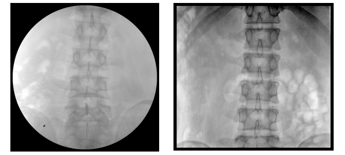 移動式平板C形臂X射線機腰椎圖像